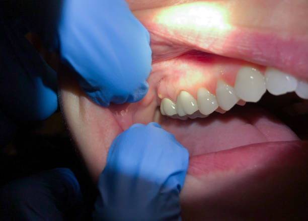 Best Cracked Tooth Emergency Dentist  in Kentfield, CA