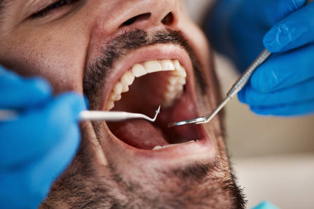 Best Chipped Tooth Repair Near Me  in Kentfield, CA
